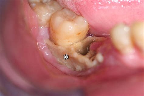 Bisphosphonate Associated Osteonecrosis Of The Jaw