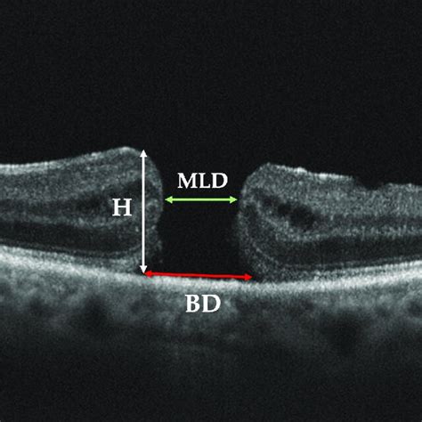 Preoperative Parameters Of Full Thickness Macular Hole FTMH On