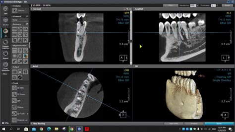 CBCT In Endodontics 3D Navigation For The Broken File In MB Canal