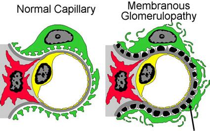 Membranous Nephropathy MN NephCure Kidney International