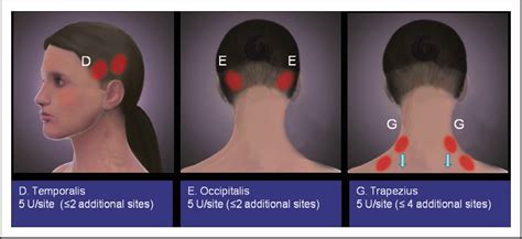 Figure 1 From Submissions Method Of Injection Of Onabotulinumtoxina For Chronic Migraine A