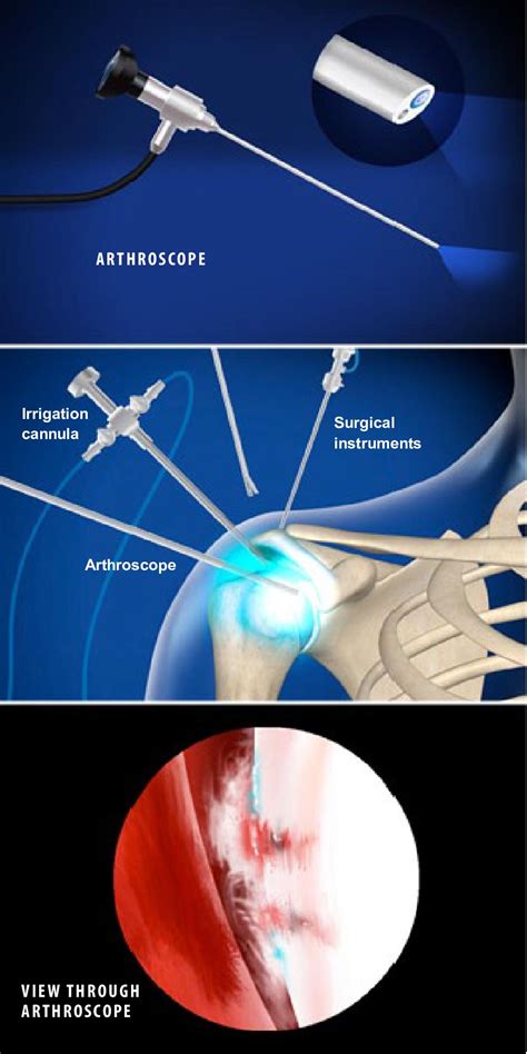 Shoulder Arthroscopy Rotator Cuff Repair | lupon.gov.ph