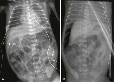 The Abdominal Wall And Peritoneal Cavity Radiology Key