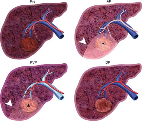 Imaging Features At The Periphery Hemodynamics Pathophysiology And