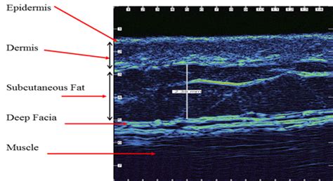 Dermatology Ultrasound Non Invasive Screening Assessment Of