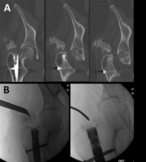 Preoperative Computed Tomography Ct Scan A And Intraoperative