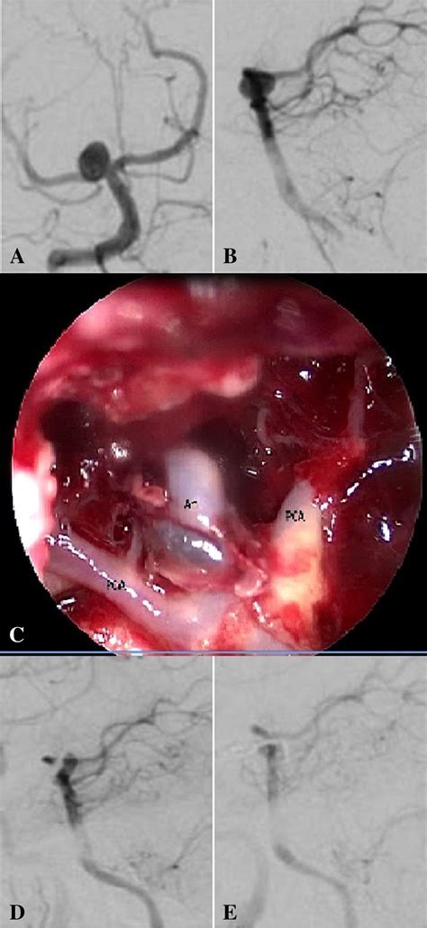 A Anteroposterior View And B Lateral View Of Left Vertebral Injection