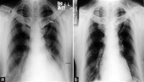 A Chest X Ray PA View Showing Cardiomegaly At The Time Of