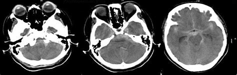 Computed Tomography Revealing Subarachnoid Hemorrhage With Thin Clot