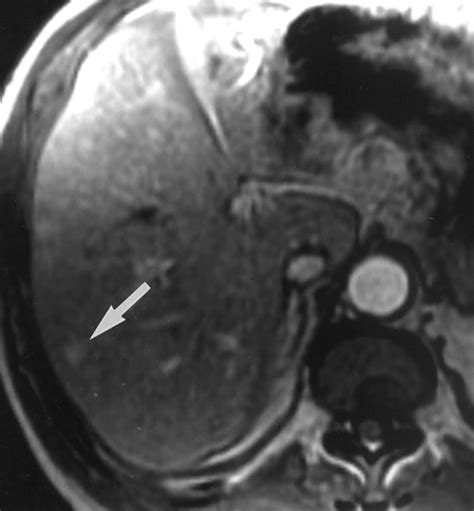 Hepatic Hemangioma Atypical Appearances On Ct Mr Imaging And