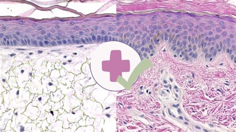 Epithelial Cell Abnormality Causes Symptoms And Treatment