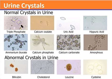 Kidney Stones Piedmont Kidney Clinic