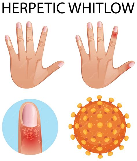 Premium Vector | Human finger with herpetic whitlow skin disease
