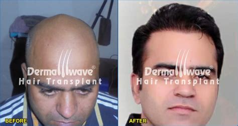 Fue Hair Transplant In Patna Id