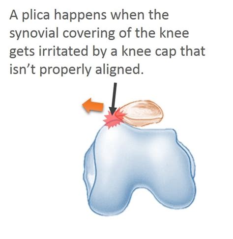 Knee Plica Surgery Recovery