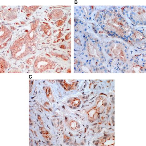 Immunohistochemical Staining Of A Upa B Upar And C Pai Expression