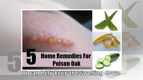 Poison Ivy Treatment And 25 Natural Rash Remedies Youtube