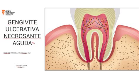 Gengivite Ulcerativa Necrosante Aguda By Grace Silva On Prezi