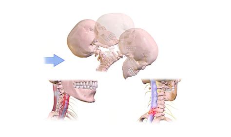 Whiplash Neck Sprain What Is Treatment Prognosis Storymd