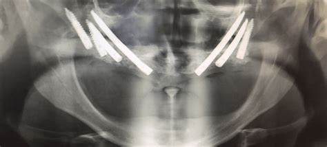 Prosthetic Rehabilitation Of Atrophic Maxilla Using EZgoma Zygomatic