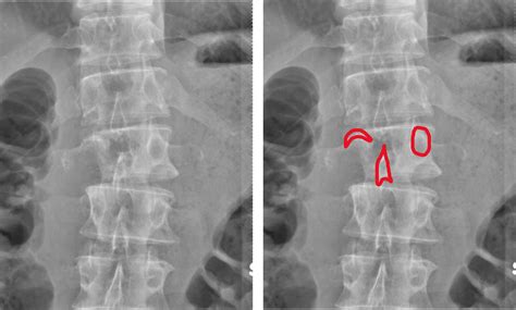 Degenerative Lumbar Spine Radiology U Of U School Of Medicine