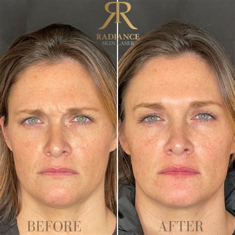 Before And After Gallery Radiance Skin And Laser Center