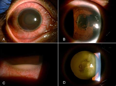 Slit Lamp Photographs Of Hla B 27 Associated Uveitis Showing A