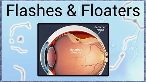 Pin on Different Types of Eye Disorder