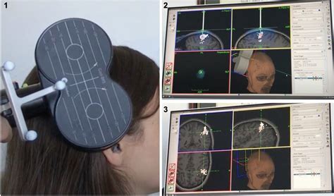 Demonstration Of Image Guided Tms Treatment A Butterfly Tms Coil Is