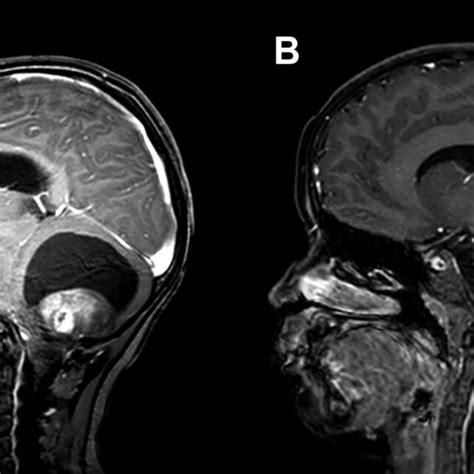 A Preoperative Mri T Sagittal Gadolinium Demonstrating A Solid Cystic