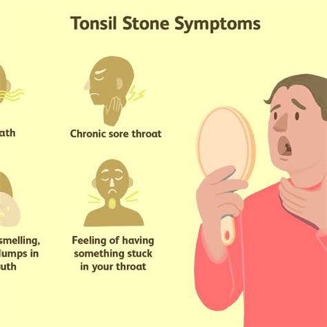 Tonsil Stones-symptoms and treatment