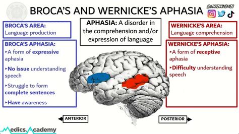 69 SECONDS on BROCA'S and WERNICKE'S APHASIA (Never get them mixed up ...