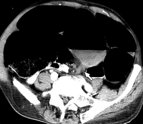 Ct Findings Of Sigmoid Volvulus Ajr