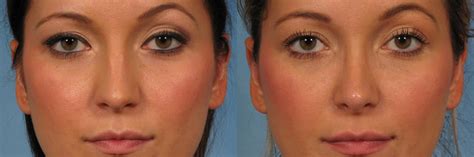 Rhinoplasty Nose Reshaping Before And After Pictures Case