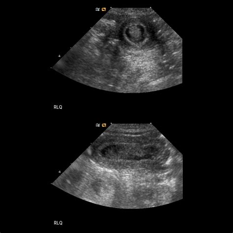 Newborn With Cystic Abdominal Mass On Prenatal Us Pediatric Radiology