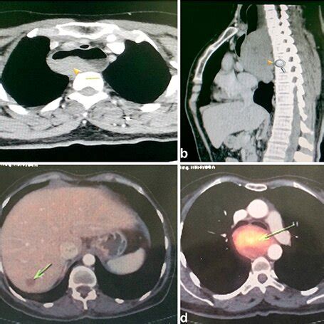 A B Contrast Enhanced Computed Tomography CT Chest Images Showing