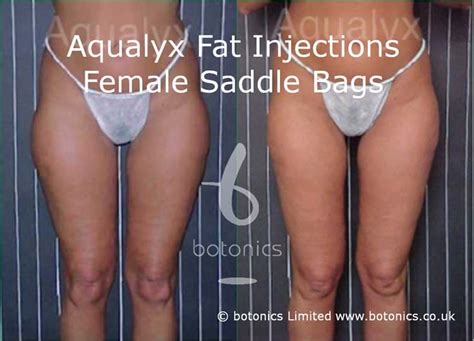 Aqualyx Fat Injections Before And After Botonics