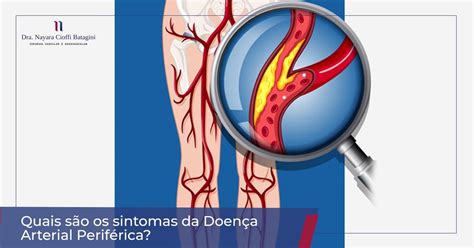 Quais São Os Sintomas Da Doença Arterial Periférica