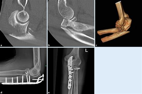 8 A 66 Year Old Patient With A Monteggia Like Lesion Badojupiter Type