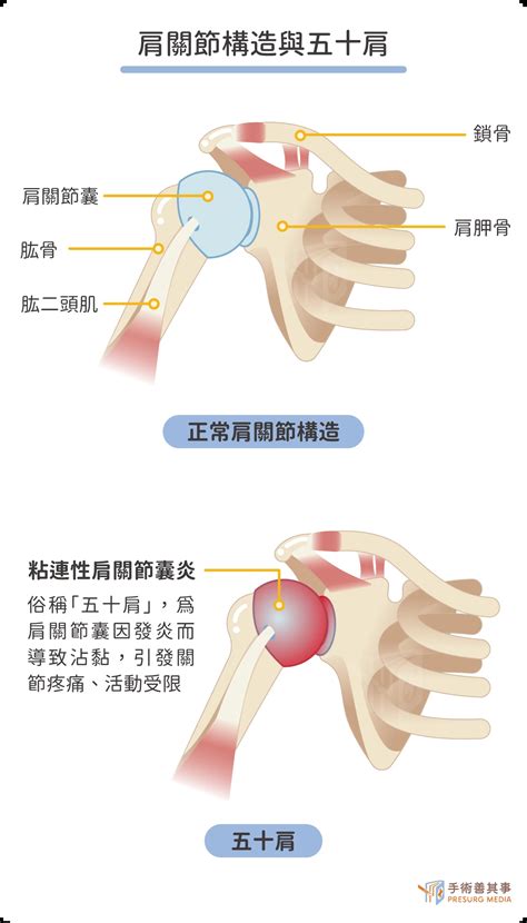 五十肩會自己好嗎？初期症狀、運動、成因、治療、復健一次看