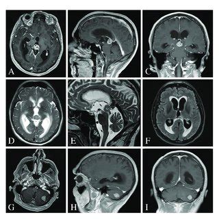 Pre Operative MRI Of The Brain A C MRI T1 Weighted Images With