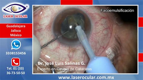 Cirugía de Cataratas con Facoemulsificación con Ultrasonido LÁSER