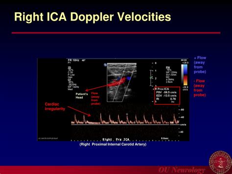 Ppt Introduction To Carotid Ultrasound And Transcranial Doppler