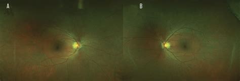 Autoimmune Retinopathy A Review