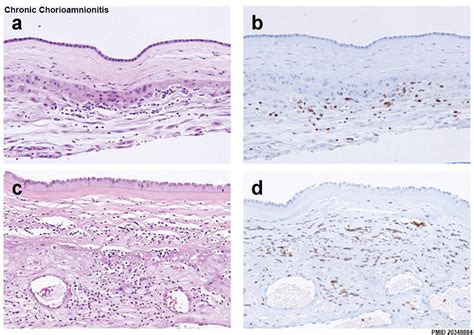 File:Chronic chorioamnionitis histology.jpg - Embryology