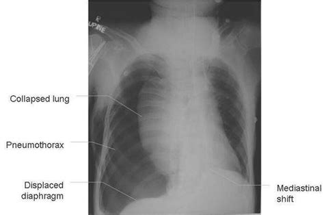 Tension Pneumothorax MEDizzy