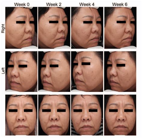 Images Show The Skin Conditions Of The Right Face Prp Injected And