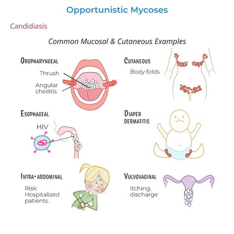 Immunology Microbiology Glossary Opportunistic Mycoses Ditki