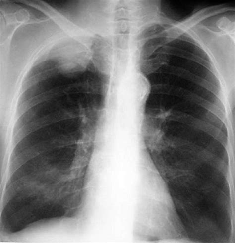 Syndrome de Pancoast-Tobias; syndrome apico-costo-vertebral; syndrome ...