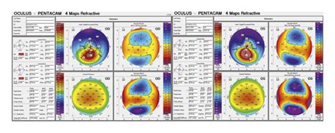 Corneal Topography Of The Proband Pentacam Od Right Eye Os Left